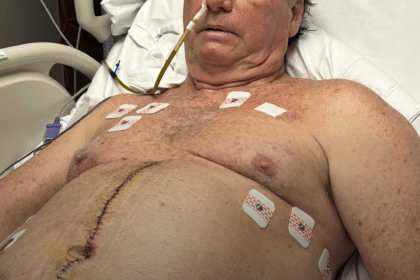 Internado na UTI em Brasília, Bolsonaro posta foto de pontos da cirurgia e dreno